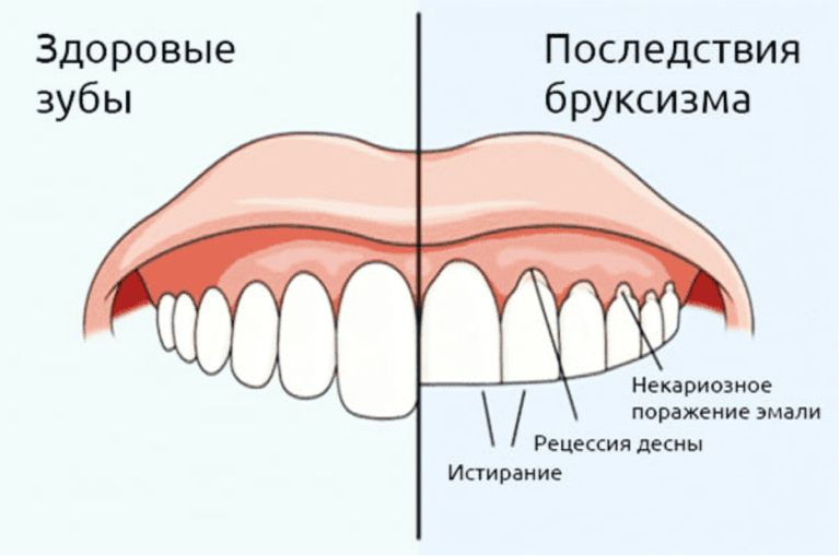 Бруксизм