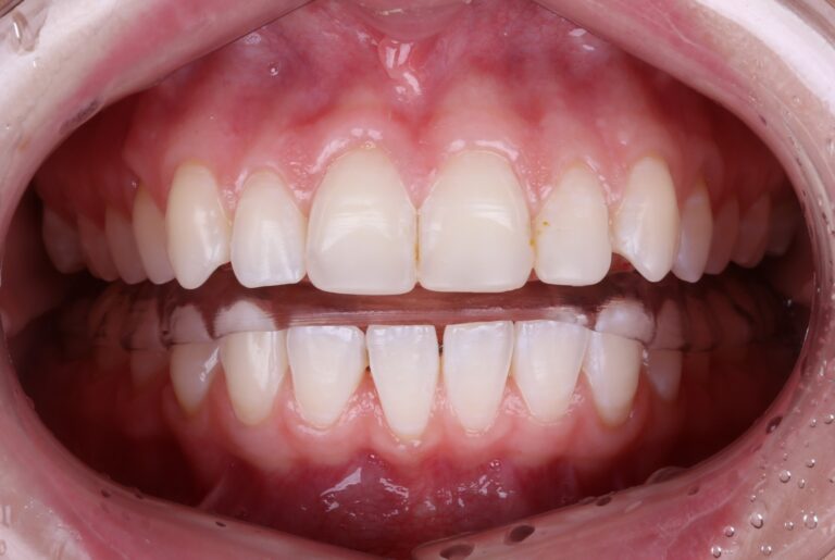 Ортотик на зубах